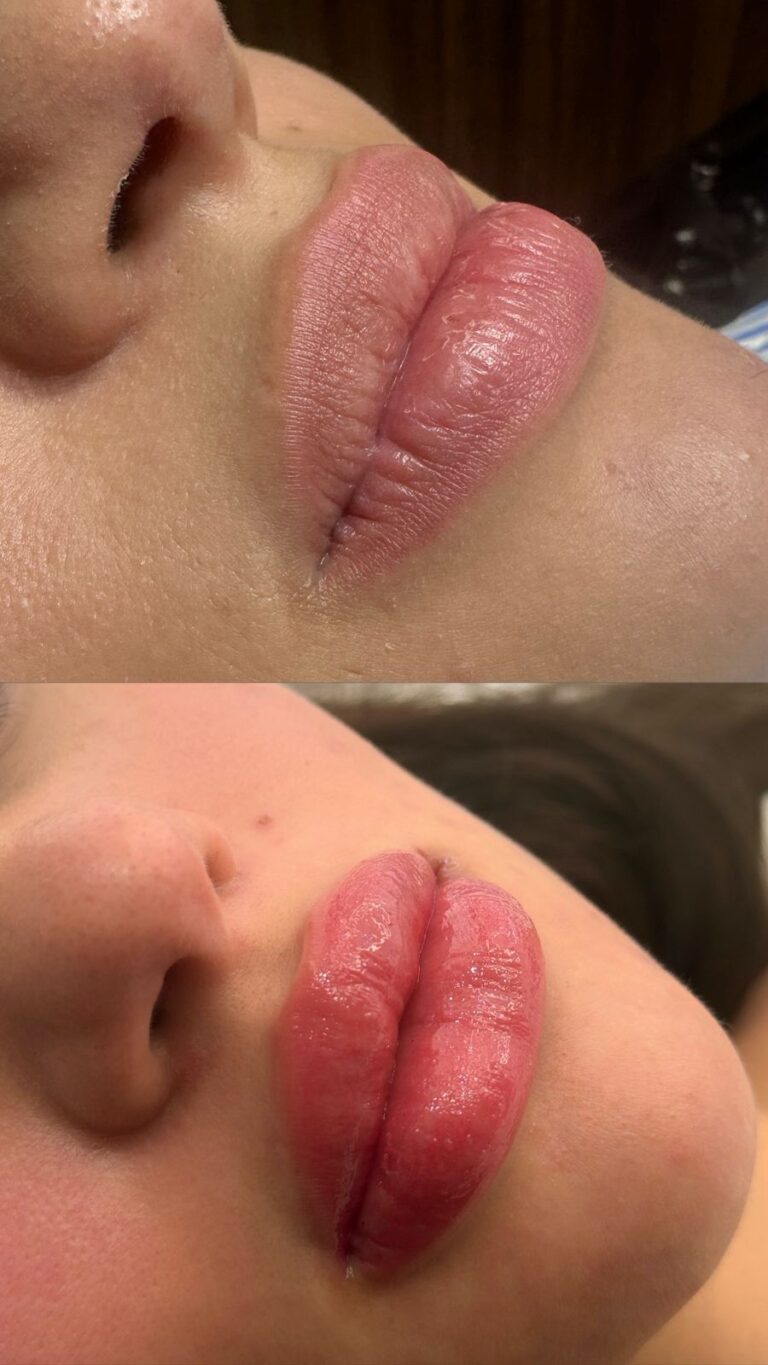 Revitalização Labial - Anna Martini