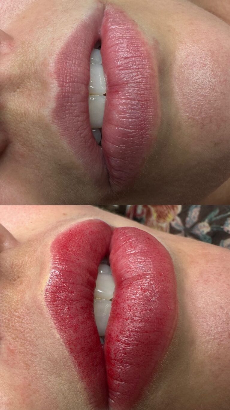 Revitalização Labial - Anna Martini