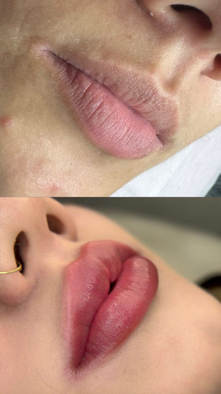 Revitalização Labial - Anna Martini