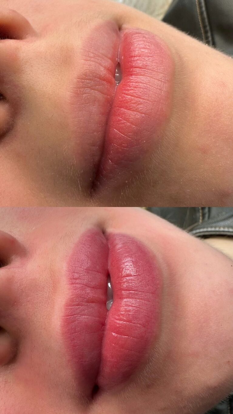 Revitalização Labial - Anna Martini