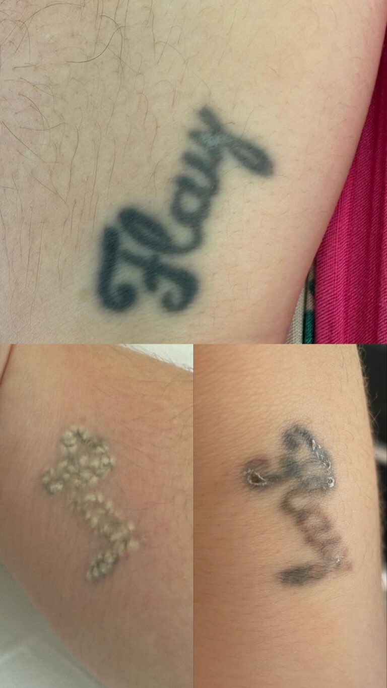 Remoção Tatuagem - Anna Martini