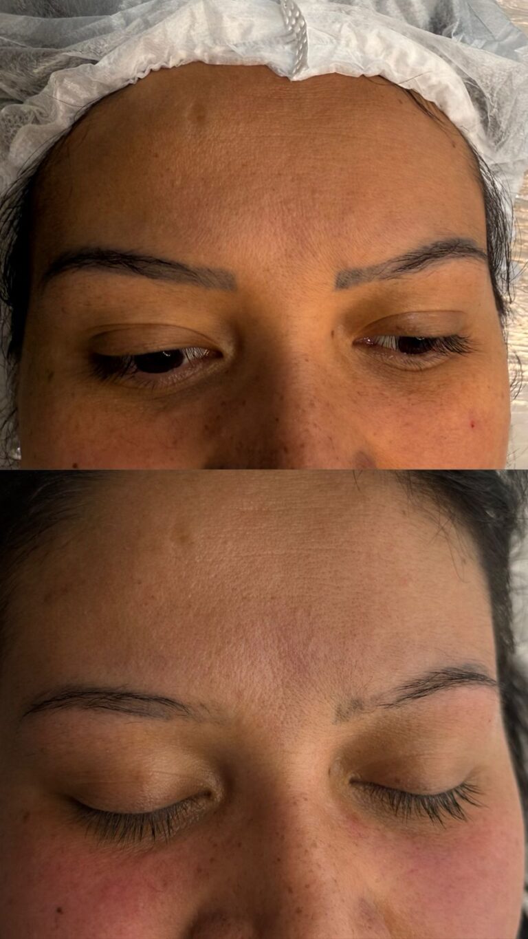 Remoção Micropigmentação - Anna Martini